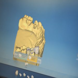 3D Implantologie